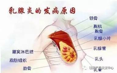 急性化脓性乳腺炎图片图片