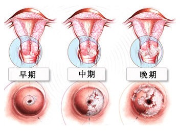 宫颈口有疙瘩图片