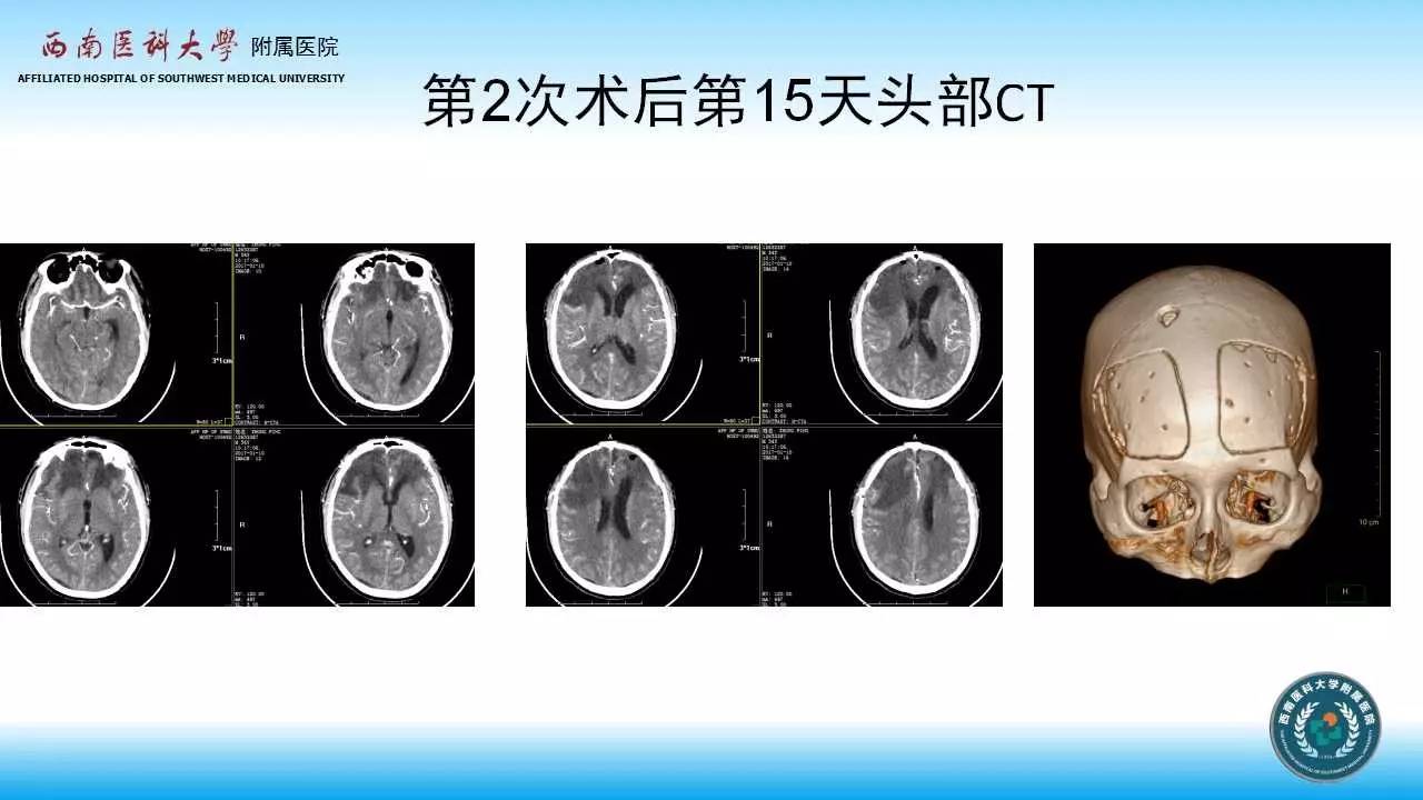 雙額葉腦內血腫清除術後二次手術1例