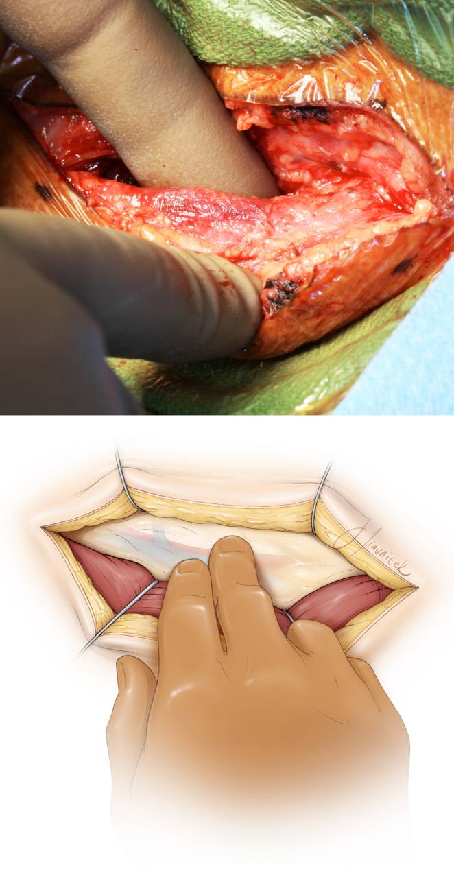 颈动脉内膜剥脱策略与技巧(carotid endarterectomy)丨the