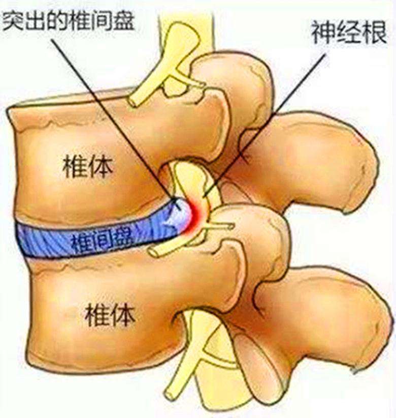 腰椎椎管矢状径图片