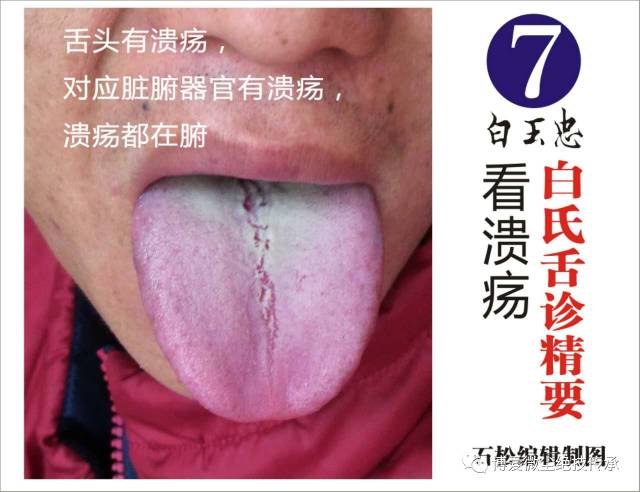 白玉忠:学会这些舌诊就足够诊断百分之70的疾病
