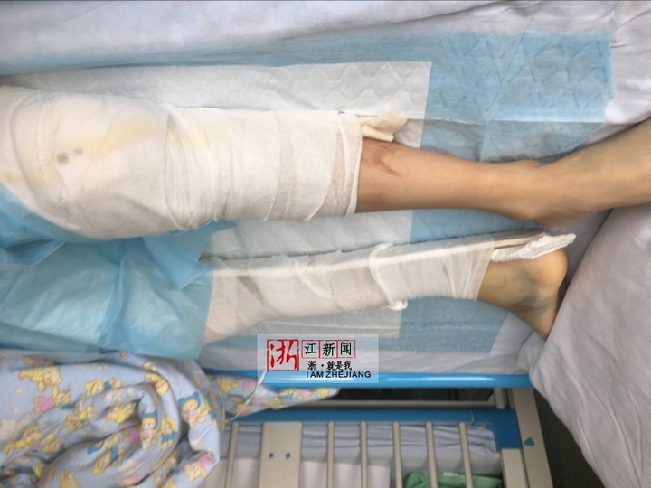 急诊创伤外科副主任赵国强说,孩子送来的时候,右股骨中段骨折,左股骨