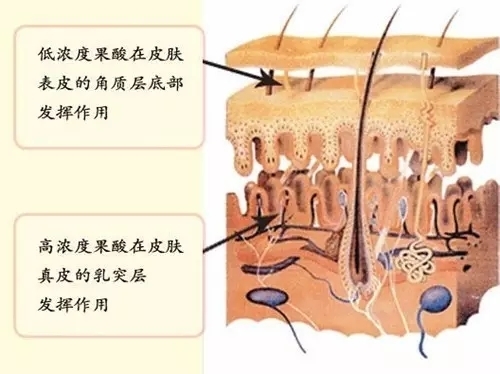 果酸换肤主要作用