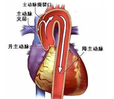 从中医的角度认清心脏主动脉病变,此症状很棘手!