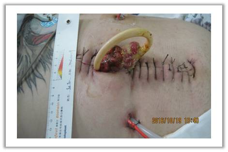 胰腺炎手术刀口图片图片
