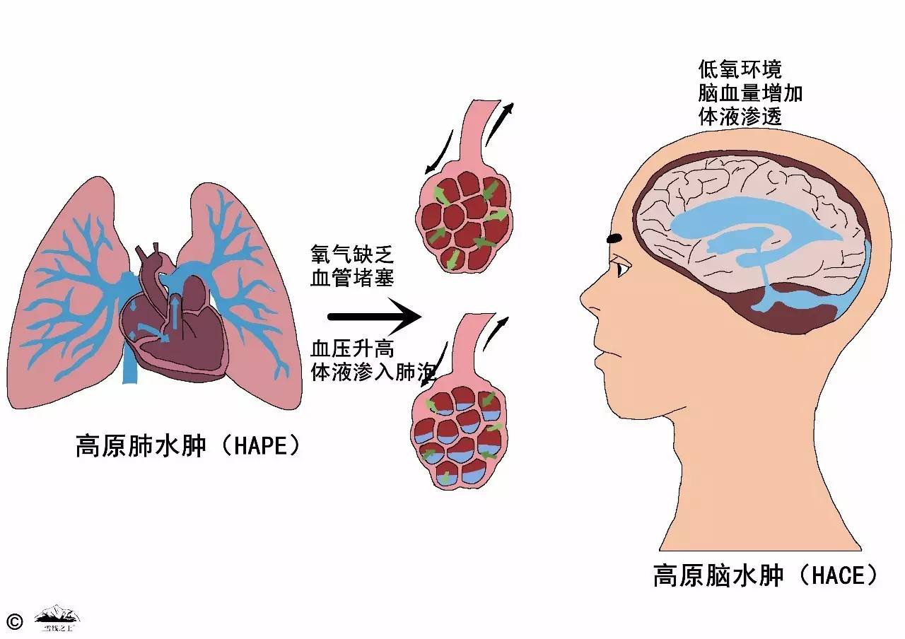 最终高反会诱发致命的高原肺水肿(hape)和高原脑水肿(hace)