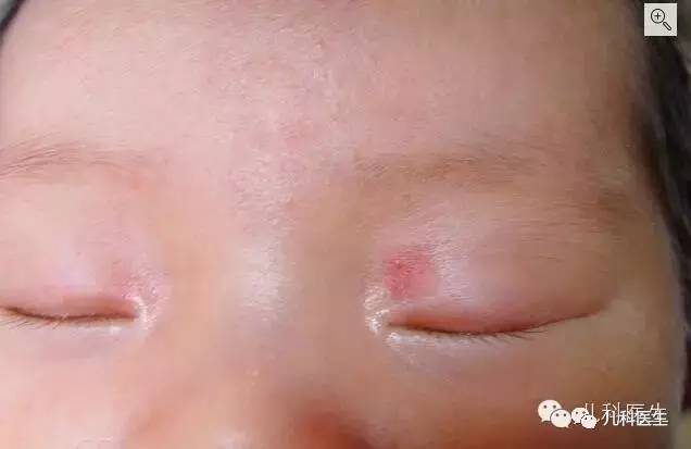 新生儿的前额和眼睑上的微血管痣,数月可消失