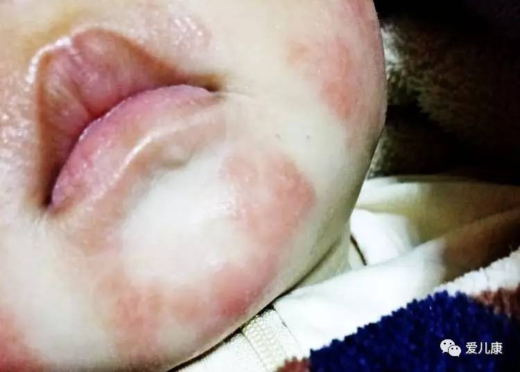 (图片由爱儿康家长提供)王艳丽医生解答:这是口周湿疹,口水刺激就会