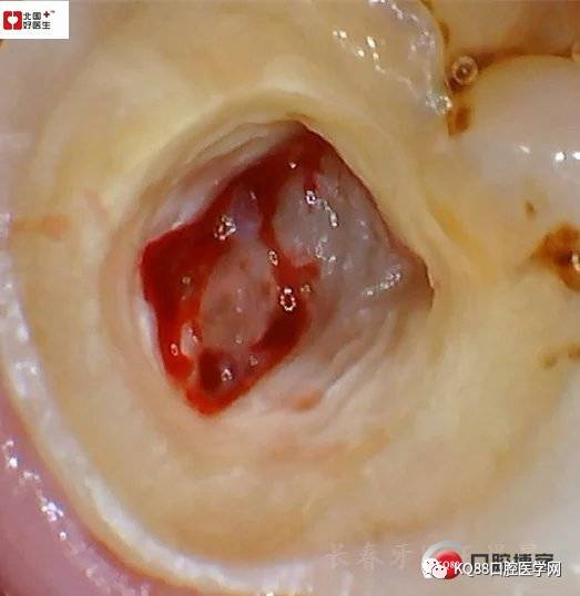 根管治疗术,术后嵌体或全冠修复诊断:26慢性牙髓炎x线检查:x片示中合