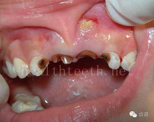 四,孩子的牙齿问题 乳牙未退,牙根穿出牙龈对上唇粘膜造成刺激