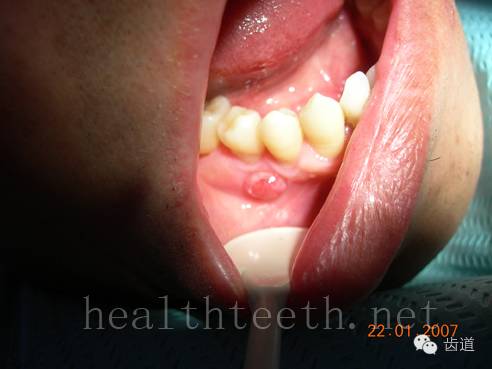 牙髓炎化脓图片