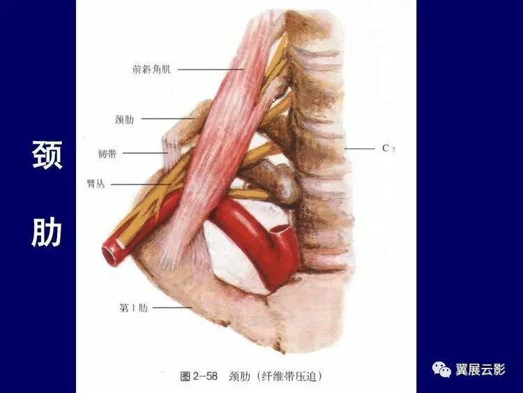 颈肋图片