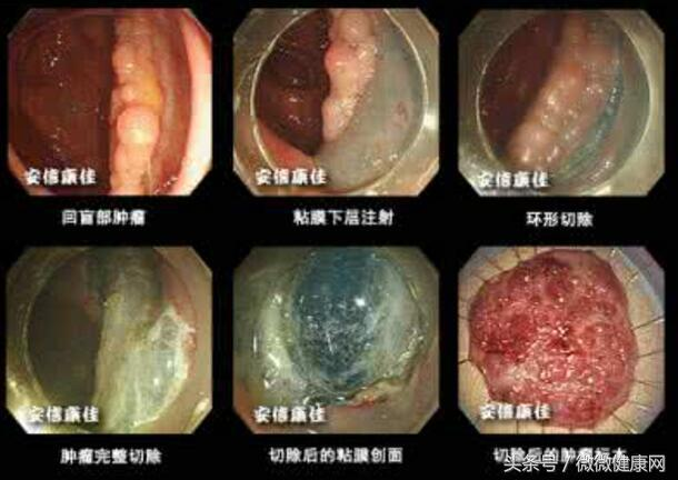 致癌的水果第一名_水果致癌第一名_水果致癌二十水果