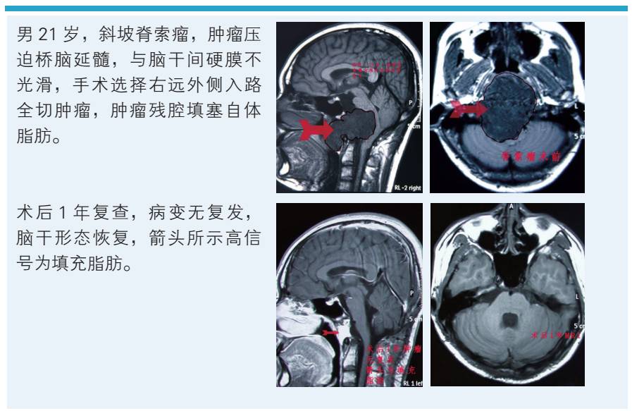 吴斌教授:浅谈中线颅底蝶窦