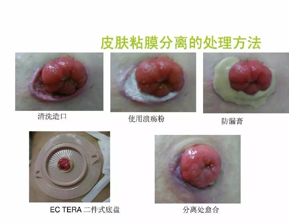 单腔造口图片图片