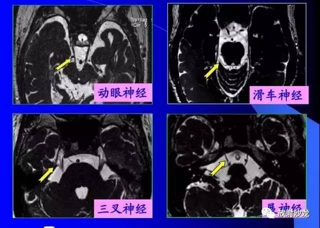 听神经解剖图核磁共振图片