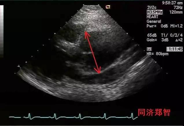 主动脉窦瘤超声图片