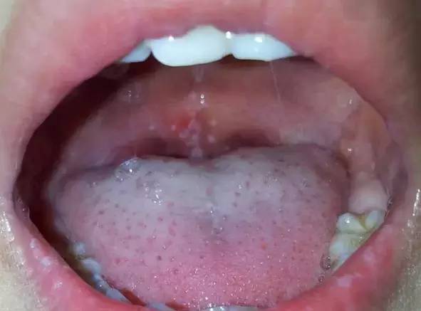 口腔软腭疼痛图片