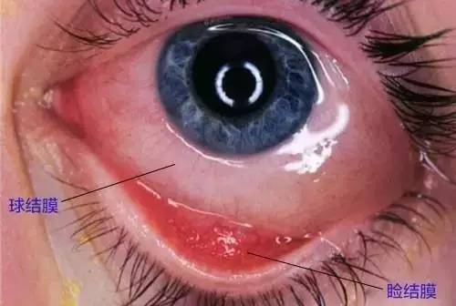 球结膜覆盖在眼球巩膜的表面,睑结膜覆盖在眼睑的内面,形成密闭的结膜