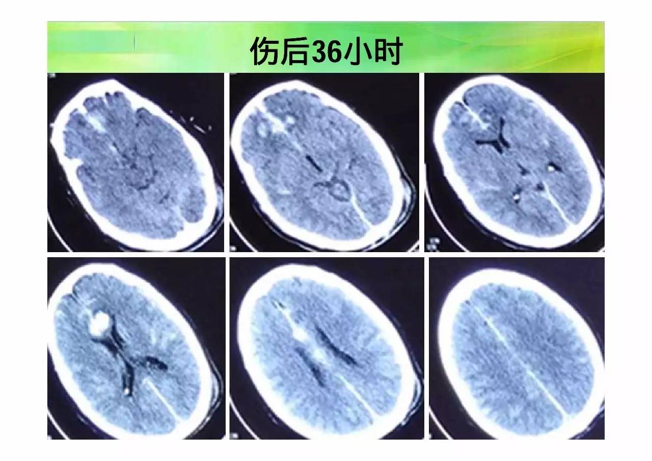 大脑额叶受损的症状图片