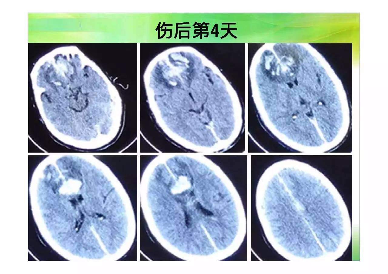 大脑额叶受损的症状图片