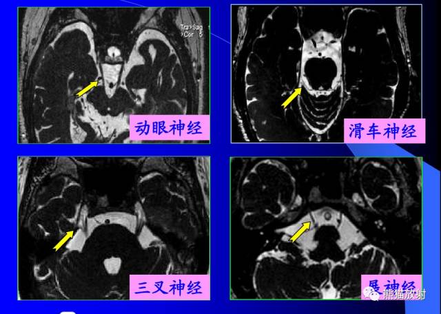 78張圖!生動漂亮的腦神經 mri 斷層解剖(收藏)