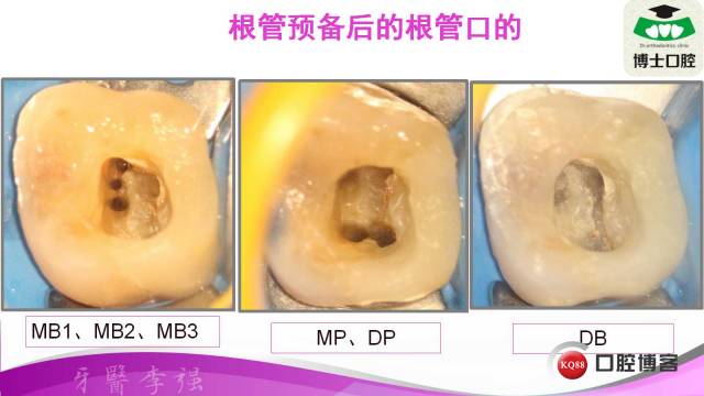 罕见上颌第一恒磨牙6根管的病例报告