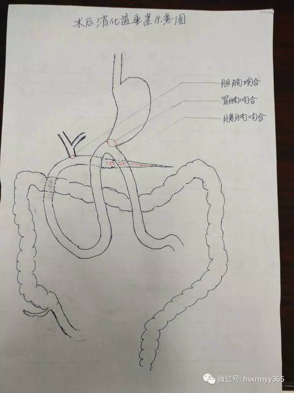 胆肠吻合术示意图图片