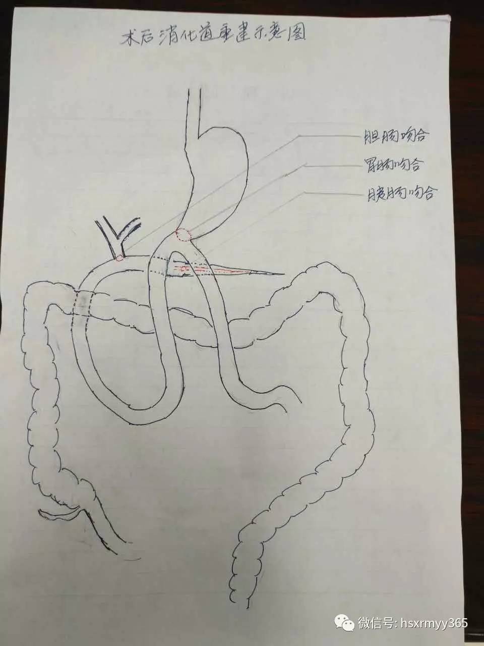 胆肠吻合图片