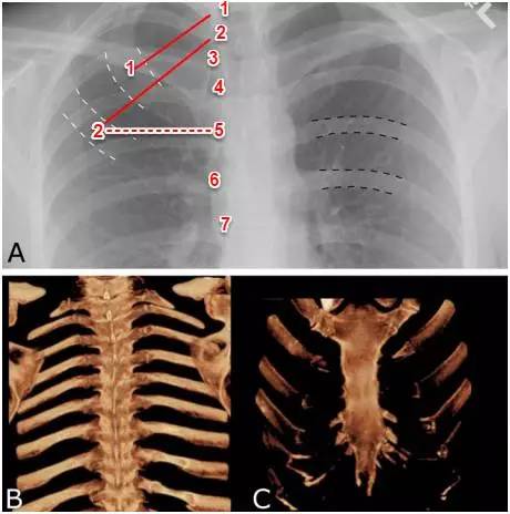 肋软骨胸片