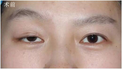 医生诊断:先天性大小眼,睁眼无力,上眼睑遮盖黑眼球超过1/2,睁眼无神