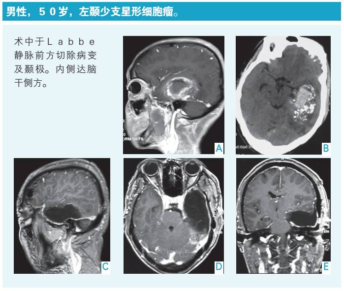 吴斌教授:谈谈几种常见部位胶质瘤的手术治疗 