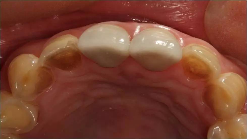 前牙磨耗患者,如何进行美学修复设计?