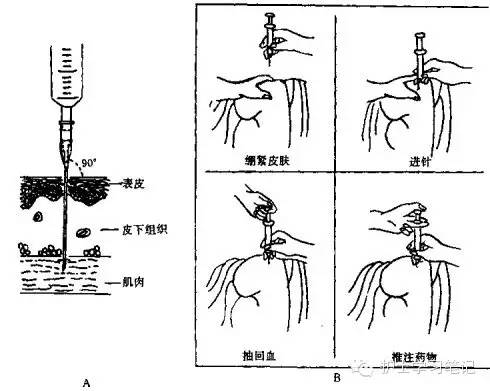 臀部肌肉注射定位方法图片