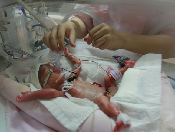 28周早产儿全身透明,医生救治24小时,暂时还活着