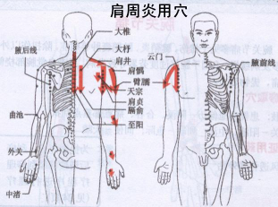 肩周炎疼痛位置图图片