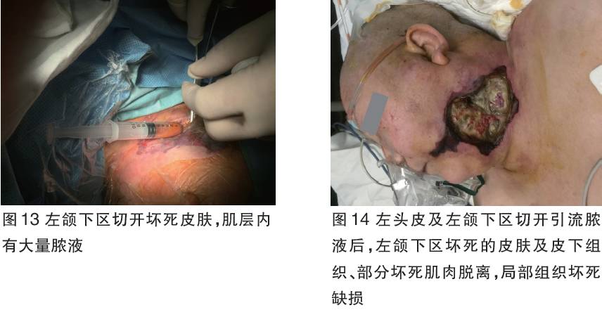 咬肌间隙感染化脓图片图片