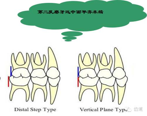 前牙区出现间隙下颌第二乳磨牙移至上颌第二乳磨牙近中磨耗明显(2)