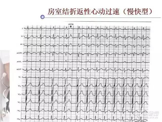 阵发性室上性心动过速的诊断与鉴别