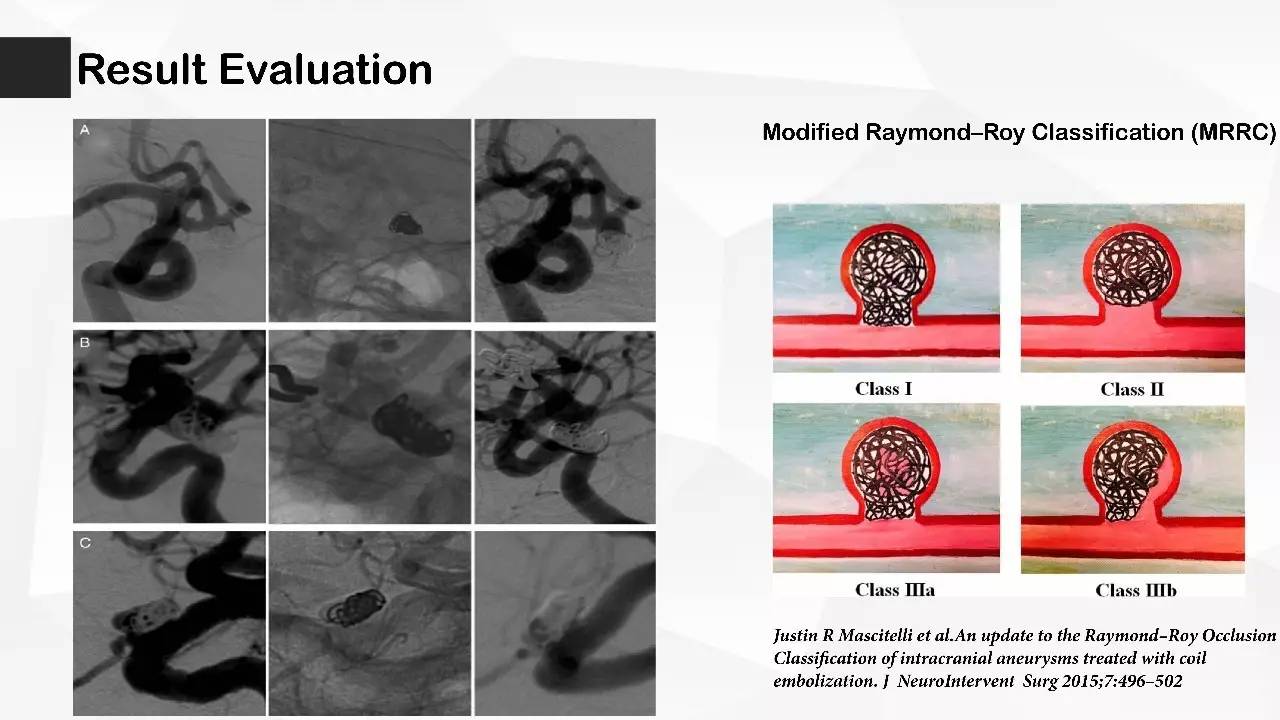 王君教授:三代支架辅助弹簧圈栓塞颅内动脉瘤的规范化报告-单中心