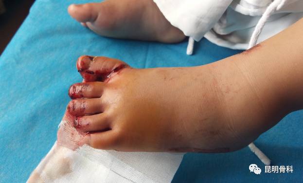 小男孩的脚 受伤图片