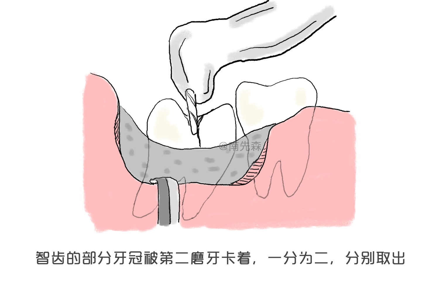 多數近中阻生智齒拔除的主要阻力來自於牙冠——智齒的部分牙冠被第二