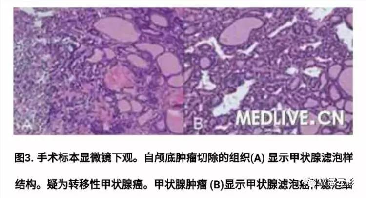 滤泡性甲状腺腺瘤图片图片