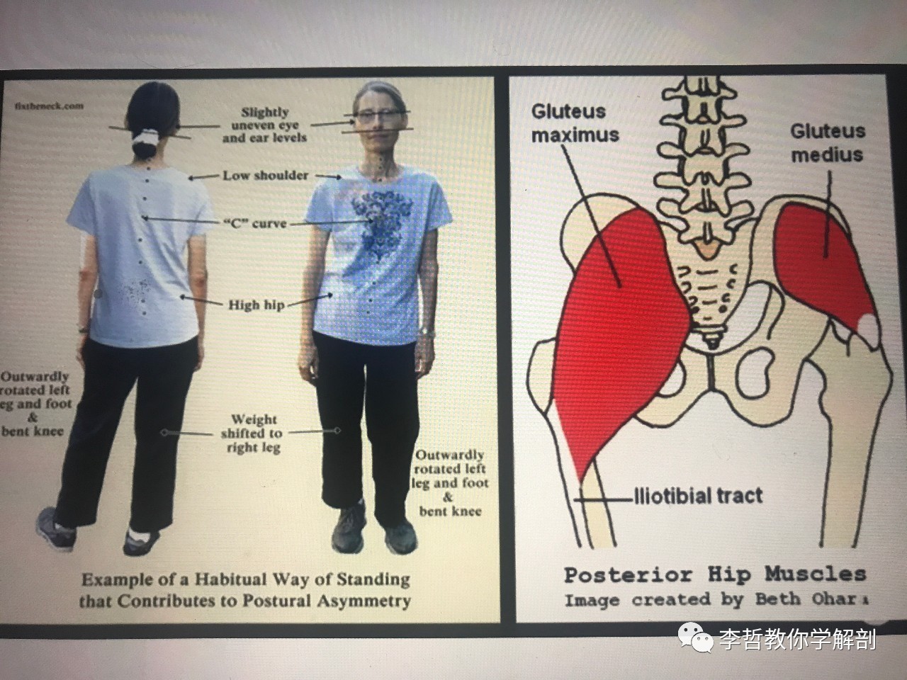 肩胛骨上移背后图图片