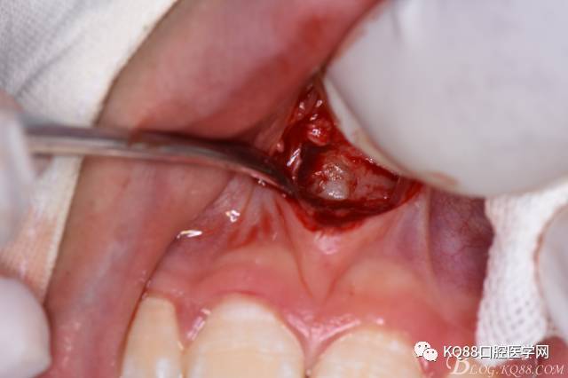 多生牙拔除手术步骤图片