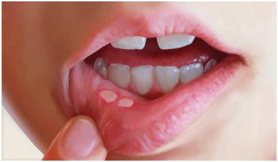口腔溃疡01(口腔溃疡,牙痛)口腔炎症5,关心高危人群,老年人,高温环境