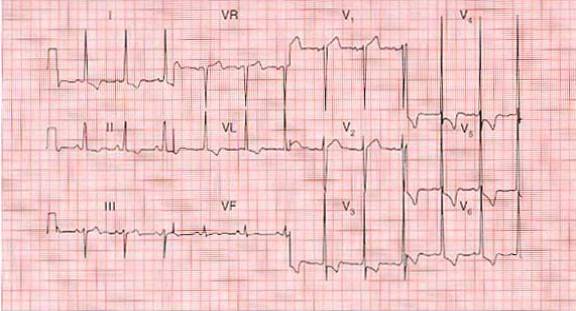 ③ 左心室肥大,正常左心室位于心脏的左后方