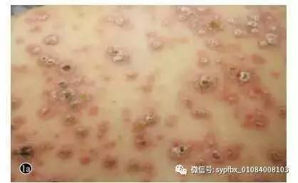 苄星青霉素梅毒图片