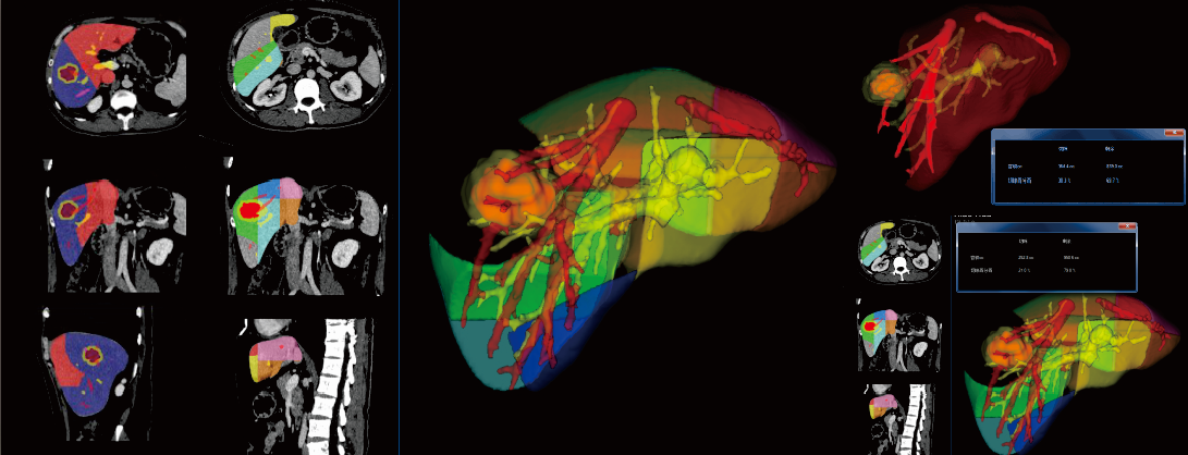 博为肝脏三维手术规划系统让肿瘤切除更精准安全